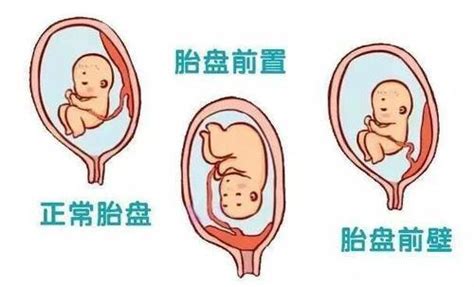 植入性胎盤是什麼 詠 筆劃